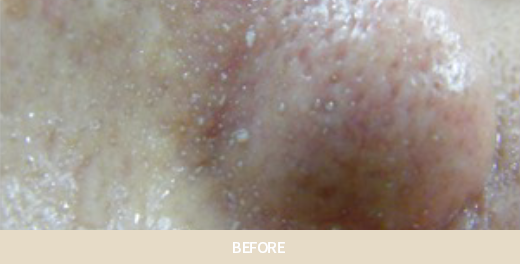 아쿠아필 치료 사진