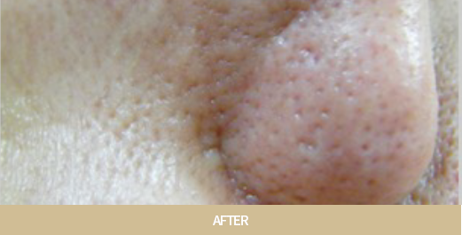 아쿠아필 치료 사진