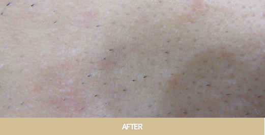 아쿠아필 치료 사진