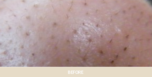 아쿠아필 치료 사진