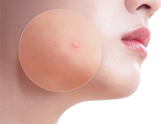 여드름관리 이미지