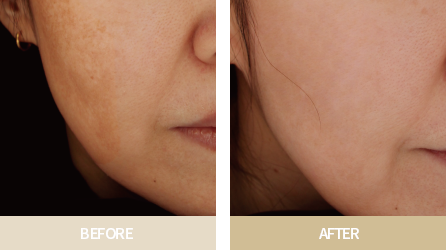 브이로RF 시술전&후 사진