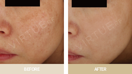 브이로RF 시술전&후 사진