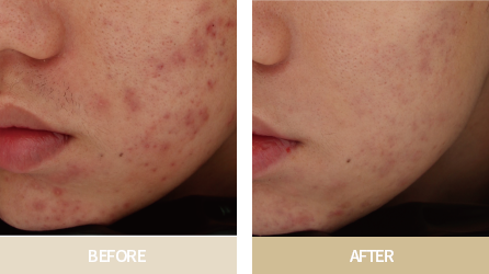 브이로RF 시술전&후 사진