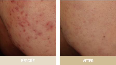 브이로RF 시술전&후 사진