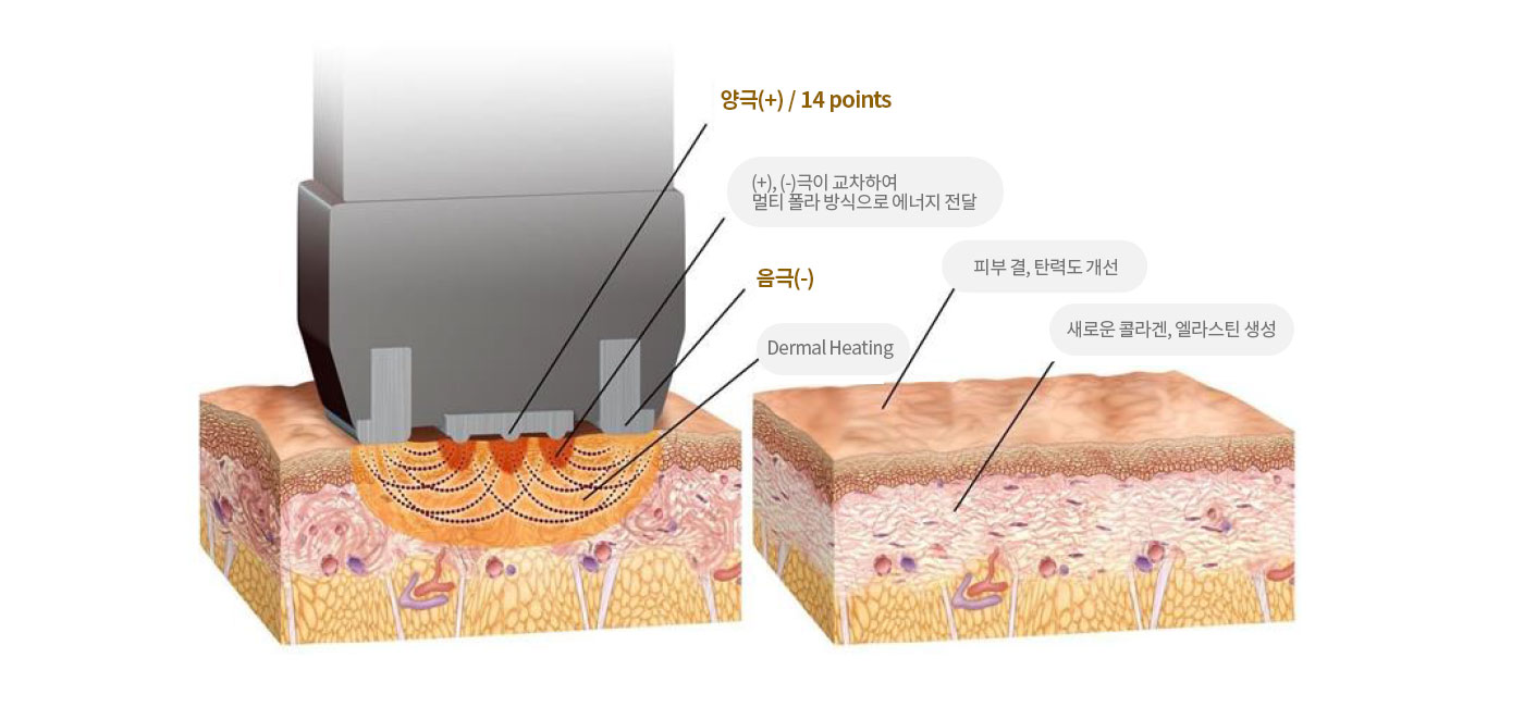 국소부위, 팔/겨드랑이, 종아리, 복부/옆구리, 허벅지