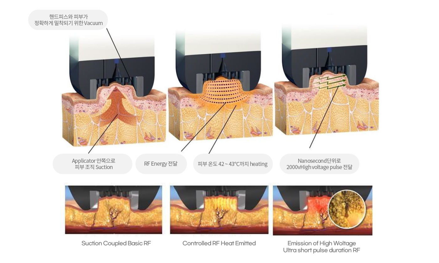 국소부위, 팔/겨드랑이, 종아리, 복부/옆구리, 허벅지